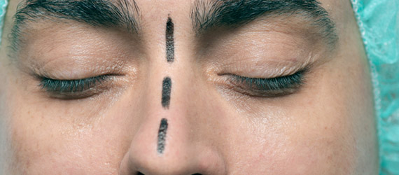 Deformidad del tabique nasal